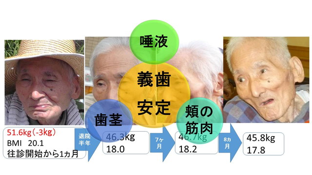 方法と取り組み 義歯の安定